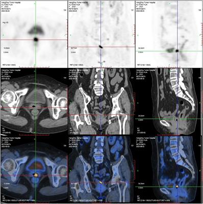 Primary vaginal cancer after hysterectomy for benign conditions: a systematic review of the literature